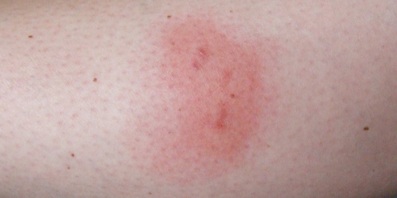 mehrere rote Stiche am Arm einer Person