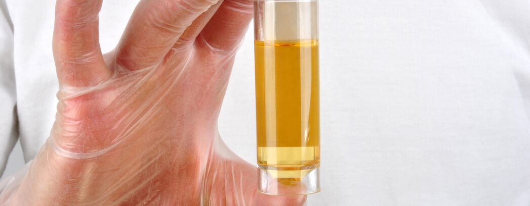 Behandschute Hand hält Glasröhrchen mit Urin