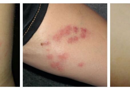 Drei Beispiele für Bettwanzenstiche beim Menschen