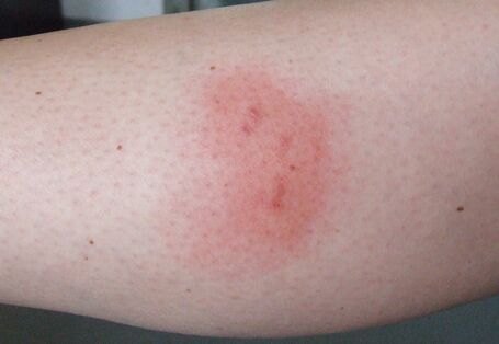 mehrere rote Stiche am Arm einer Person